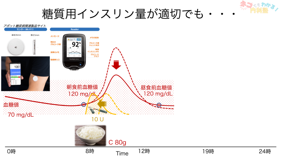 糖質インスリン比が適切でも2