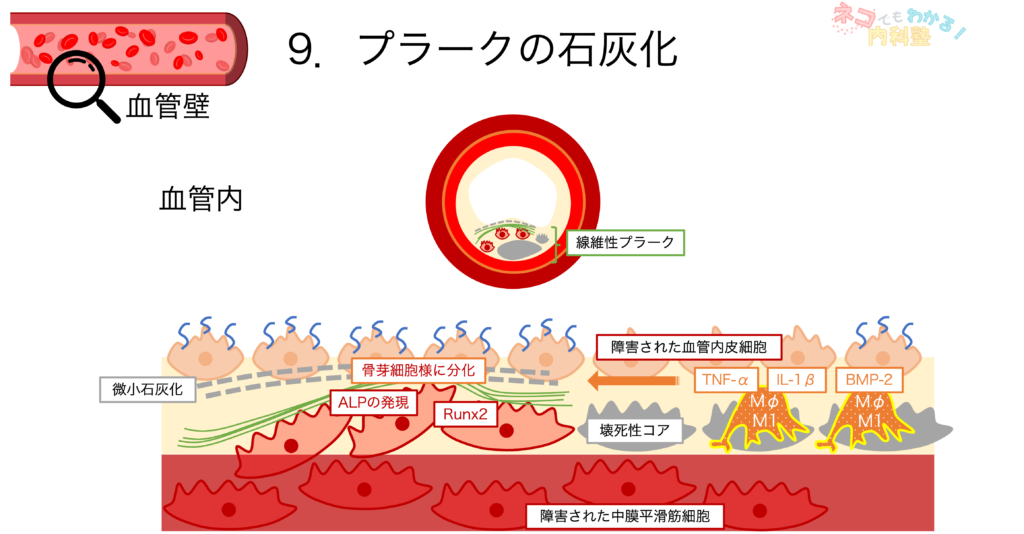 プラークの石灰化