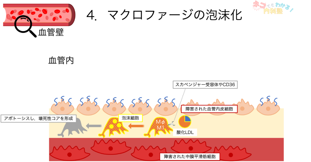 マクロファージの泡沫化