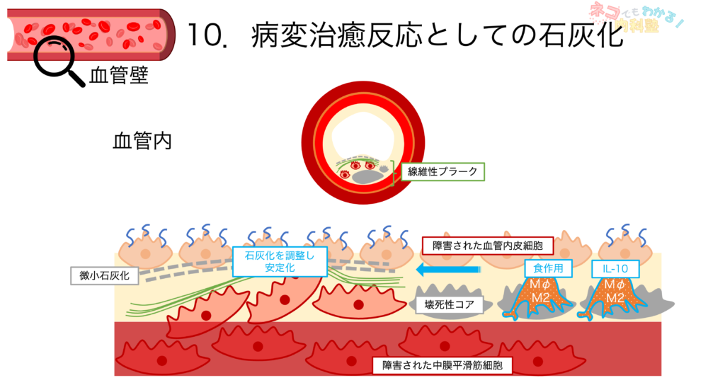 病変治癒反応としての石灰化