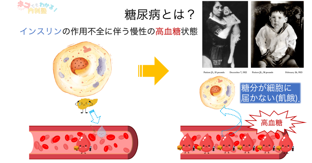 糖尿病とは