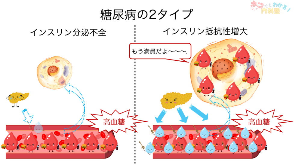 糖尿病の2タイプ