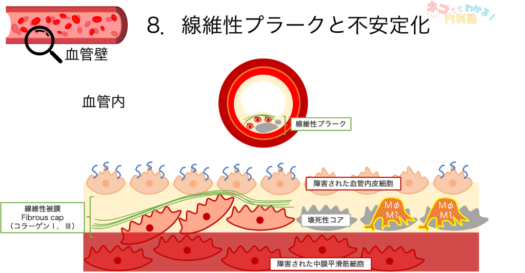 線維性プラークと不安定化